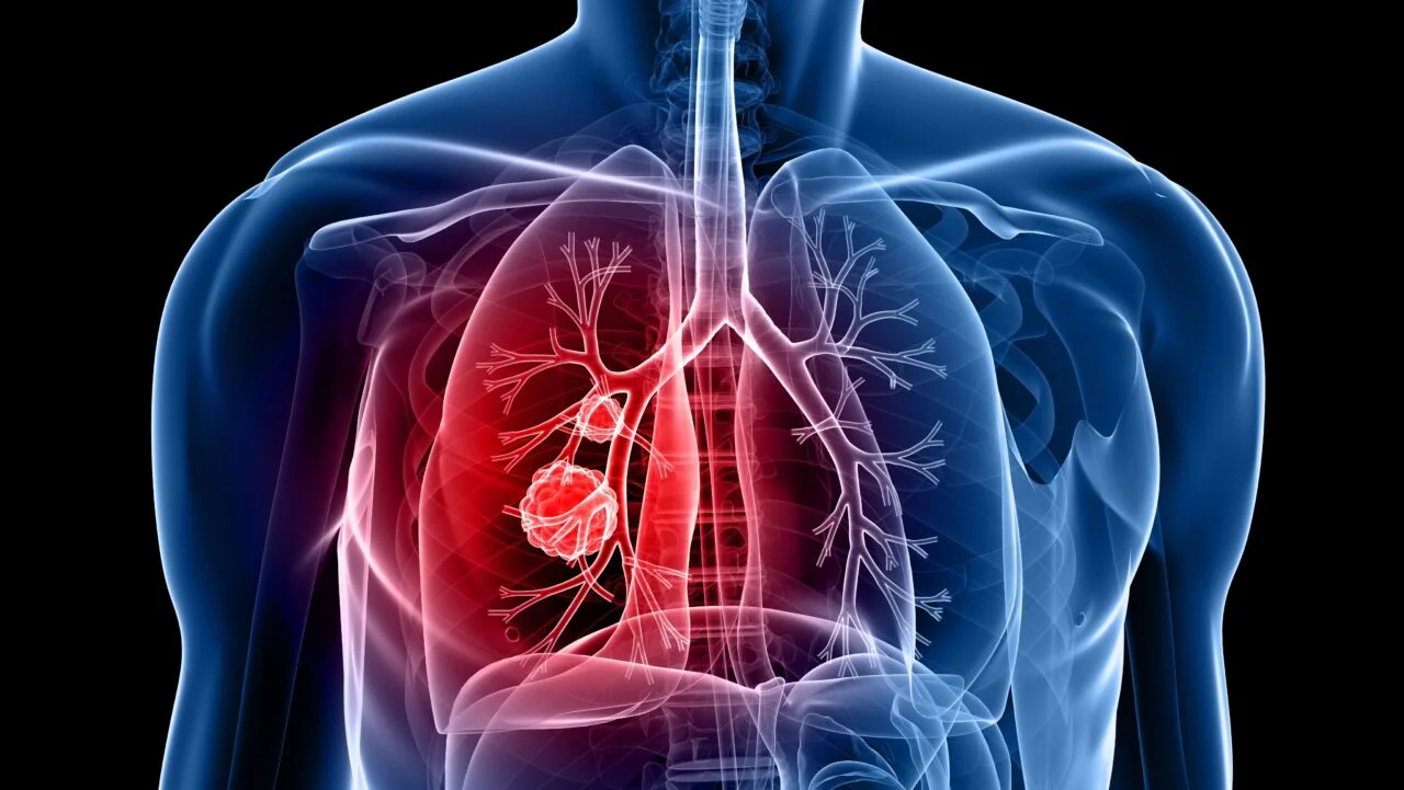 Lung Cancer